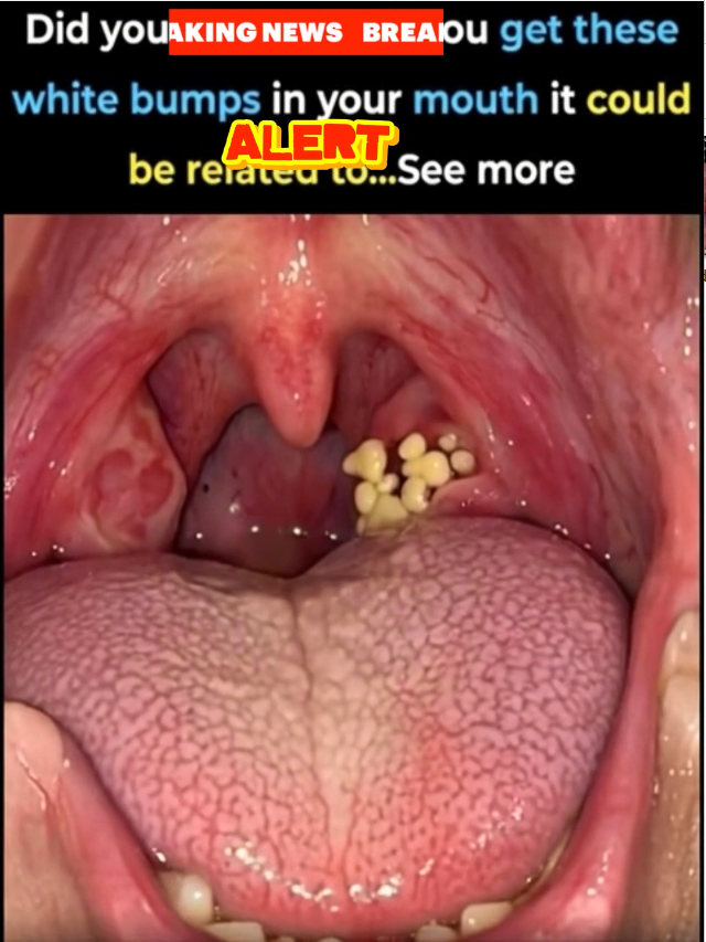 𝐃𝐢𝐝 𝐲𝐨𝐮 𝐤𝐧𝐨𝐰 𝐭𝐡𝐚𝐭 𝐢𝐟 𝐲𝐨𝐮 𝐠𝐞𝐭 𝐭𝐡𝐞𝐬𝐞 𝐰𝐡𝐢𝐭𝐞 𝐛𝐮𝐦𝐩𝐬 𝐢𝐧 𝐲𝐨𝐮𝐫 𝐦𝐨𝐮𝐭𝐡, 𝐢𝐭 𝐜𝐨𝐮𝐥𝐝 𝐛𝐞 𝐫𝐞𝐥𝐚𝐭𝐞𝐝 𝐭𝐨... 𝐒𝐞𝐞 𝐦𝐨𝐫𝐞 